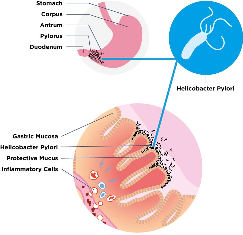 zelodec_Helicobacter_pylori